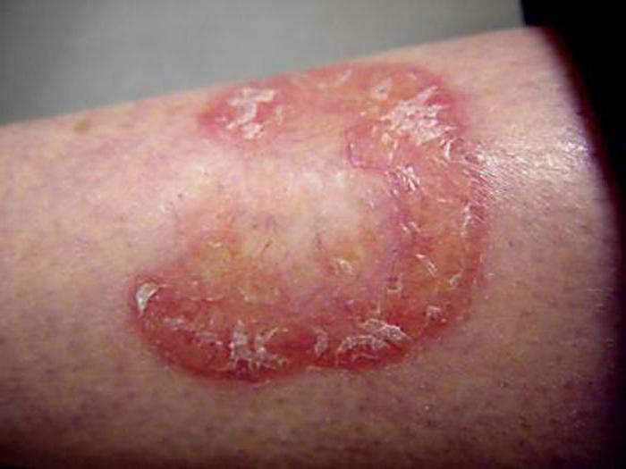 lipoid necrobiosis皮膚の
