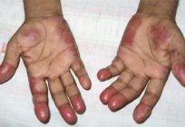 Necrobiosis lipoidica:原因、症状、診断、治療