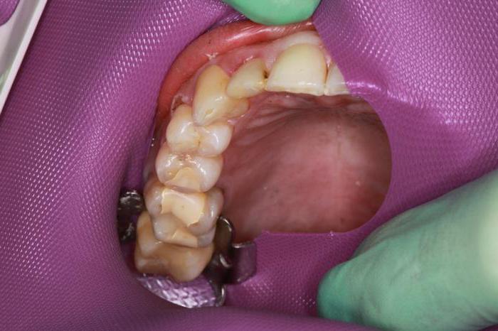 dental dam in dentistry