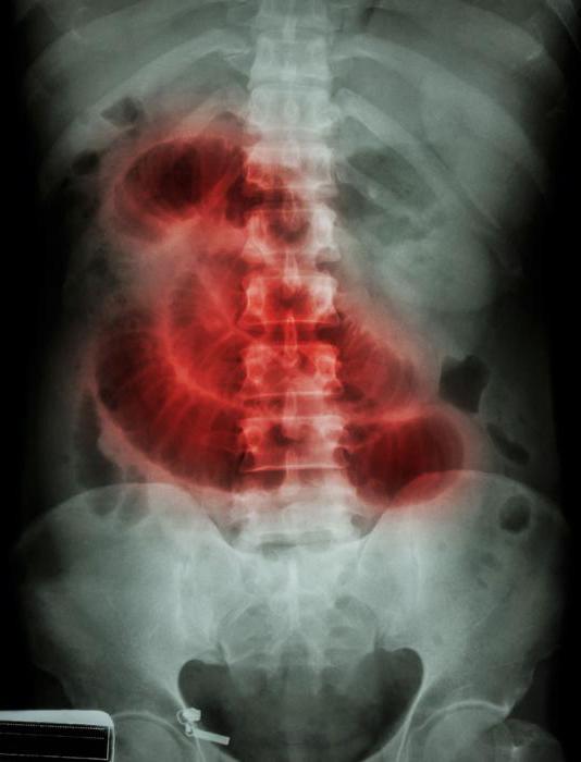 Röntgenaufnahmen des Bauches