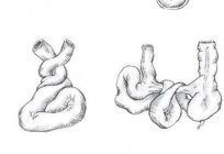 La copa de la Клойбера a rentgenologicheskom el estudio de la cavidad abdominal
