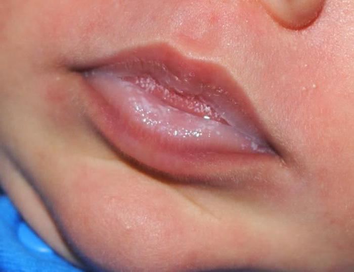 флуконазил oral para as crianças