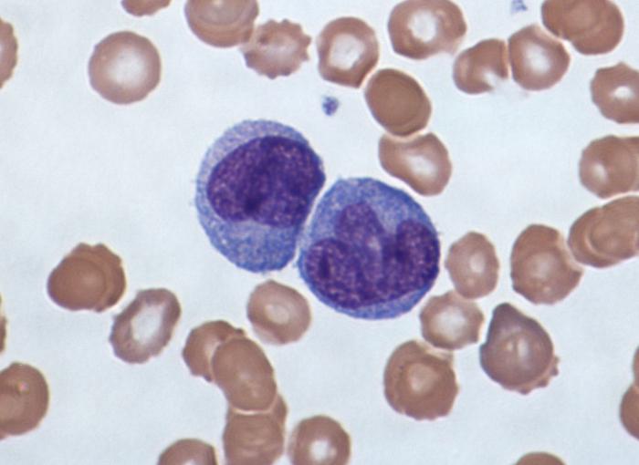 elevated monocytes in blood of the child