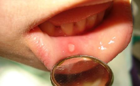 stomatitis in a child signs