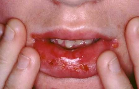 zapalenie jamy ustnej u dzieci ile dni
