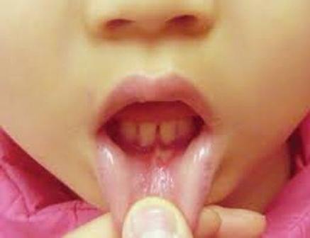 stomatitis in a year-old baby