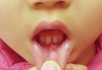 Stomatitis in a child. Signs of the disease