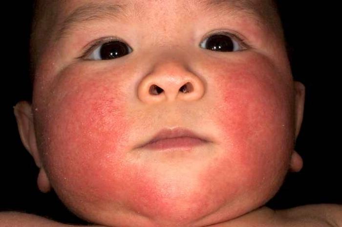how to treat dermatitis in infants