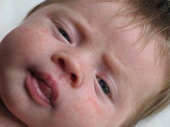 dermatitis on the baby's face