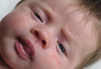 Dermatitis in infants: causes and methods of treatment