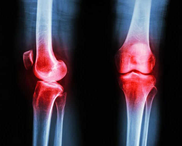 手术更换膝关节
