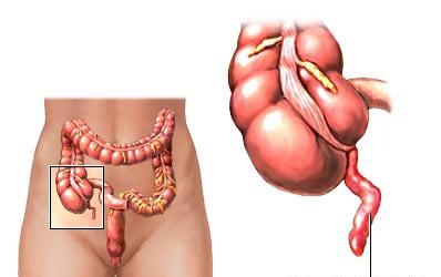 os sintomas de apendicite crônica