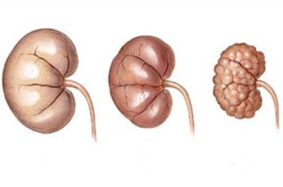 stages of CKD according to creatinine