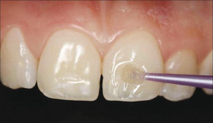 楔形的牙齿缺陷的原因和治疗