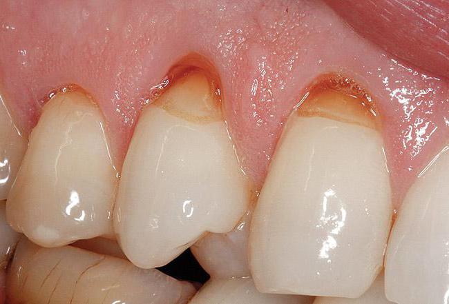 楔形的牙齿缺陷的原因