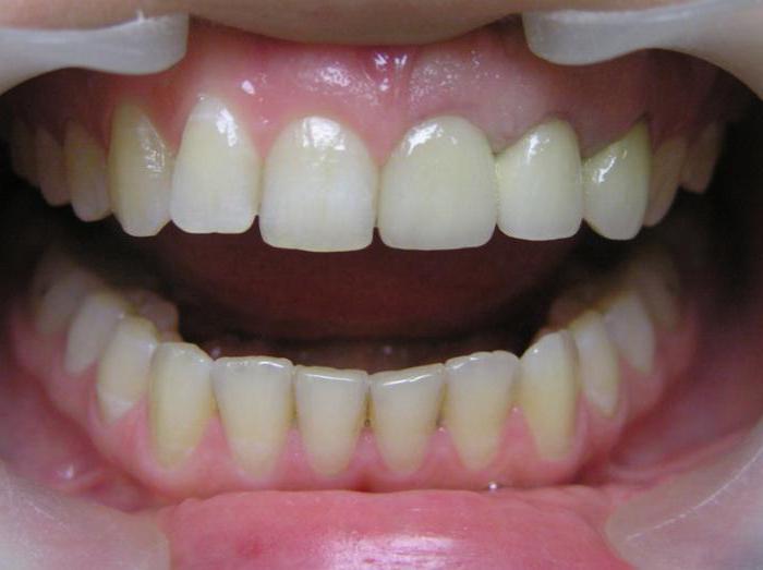 治疗楔形缺陷牙齿