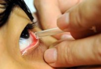 Jak leczyć слезящийся oczu?