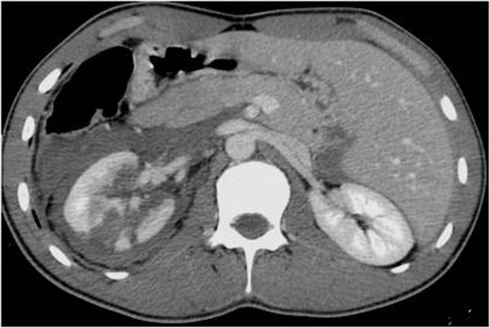 コンピュータ断層撮影CTスキャンの腎臓