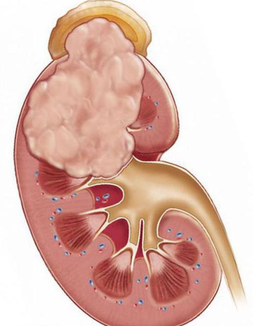 CTスキャンの腎臓の準備