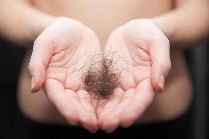 alopecia androgenética em mulheres