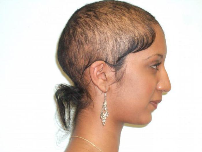 la alopecia, que es el de la mujer