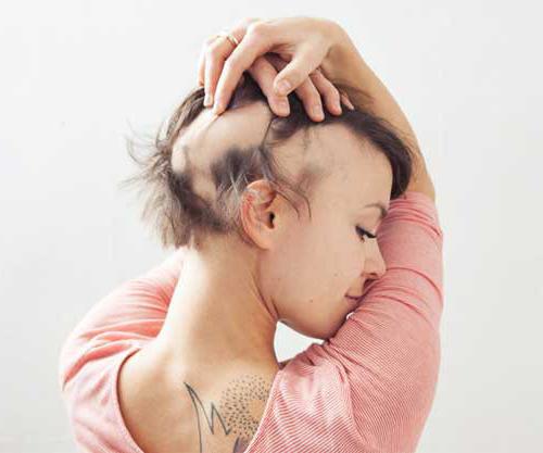la alopecia en la mujer de la foto