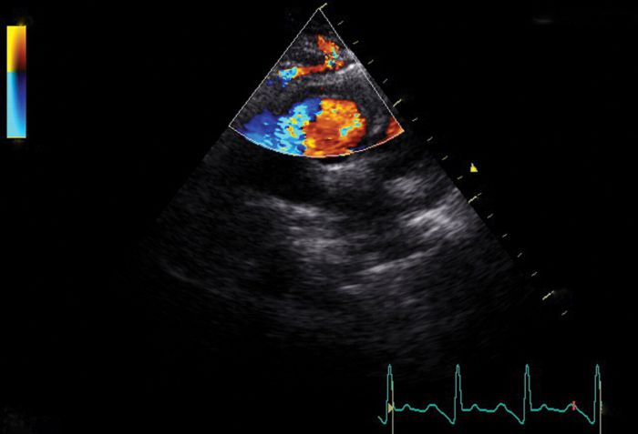 systolic murmur at the apex of the heart