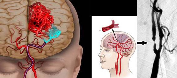 Prevention of cerebral stroke in women