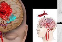 A brain stem stroke prevention. Folk remedies for stroke prevention