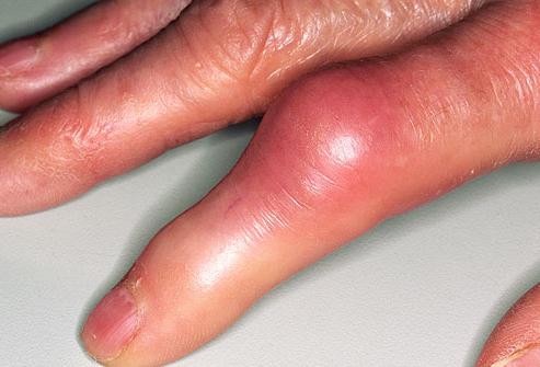 関節の炎症の指の