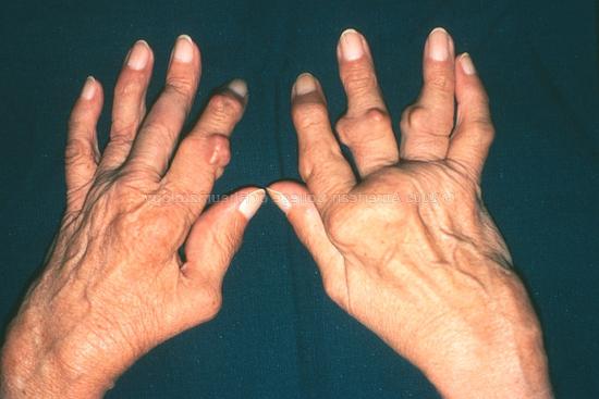 Arthritis der Gelenke der Finger