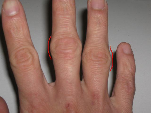 関節リウマチの関節指の手で処理