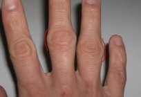如何对待民间补救办法的关节发炎的手指