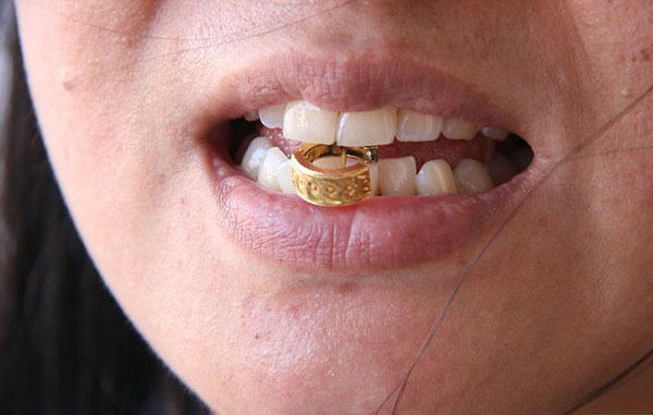 एक विधि सोने की मिश्र धातु के दांत