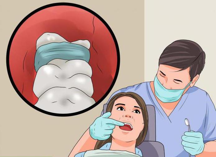 alveolitis後の歯の抽出処理