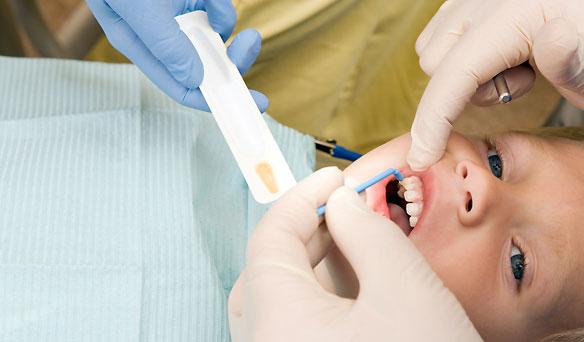 фторування зубів у дітей