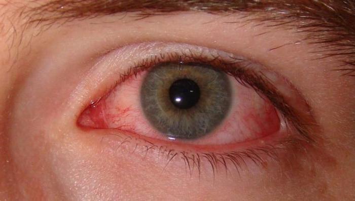 krwionośne w oczach czerwone