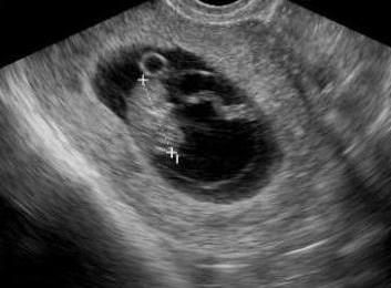 um embrião de ultra-som de 6 semanas