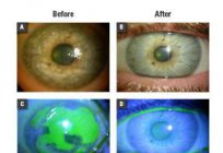 Die Erosion der Hornhaut des Auges: Symptome, Ursachen und Behandlung