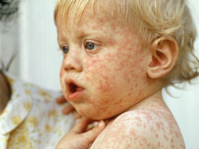 疾病麻疹的照片