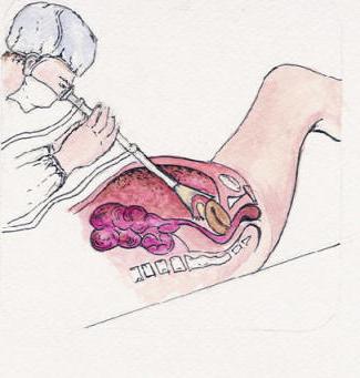 phrenicus symptom in gynecology