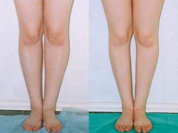 Korrektur der falschen Krümmung der Beine