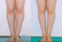 Korrektur der Krümmung der Beine: moderne Methoden und Verfahren