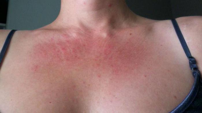 एलर्जी से पैच करने के लिए क्या करते हैं