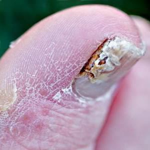  proud flesh near nail treatments on the hand