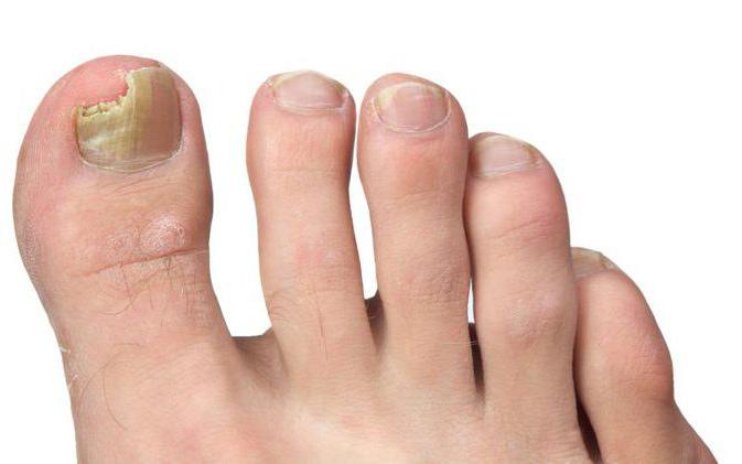العلاج من اللحوم البرية على إصبع القدم الكبير