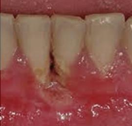 a doença periodontal causas
