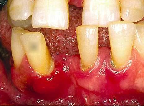 causes of periodontitis