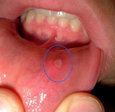 the cure stomatitis in children