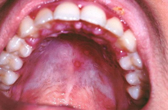 stomatitis in a child 2 years